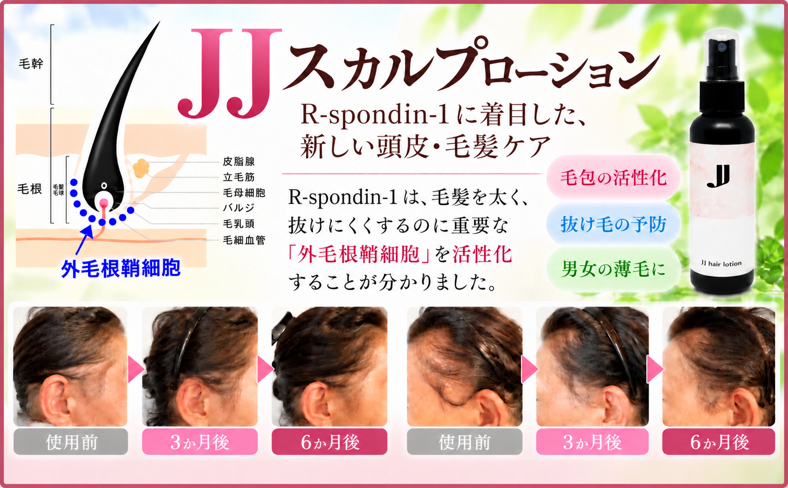 女性の薄毛